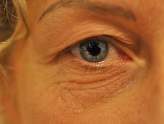 Augenlidstraffung - Beispiel 1 vorher
