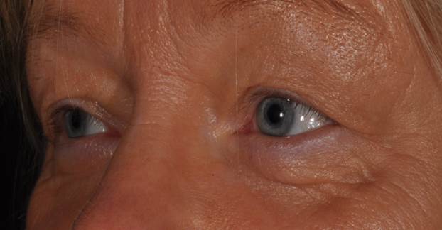 Augenlidstraffung - Beispiel 2 vorher